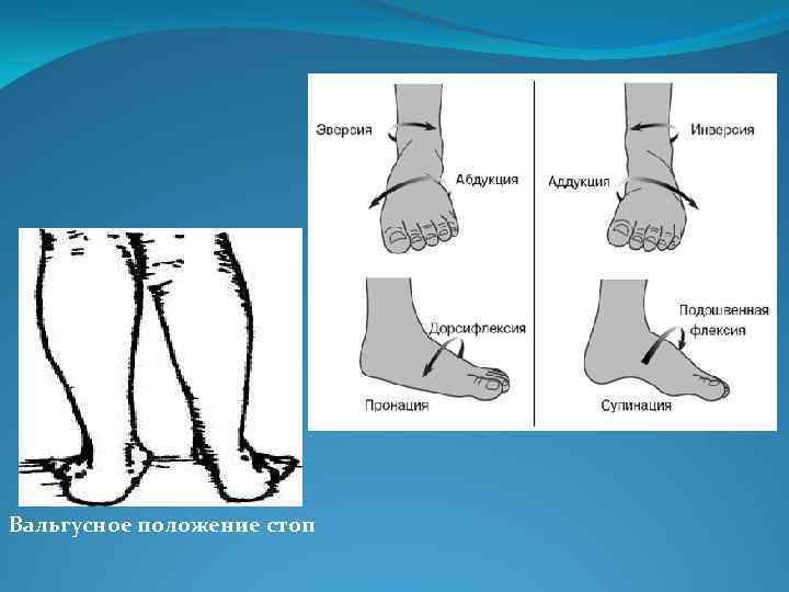 Вальгусное положение стоп 