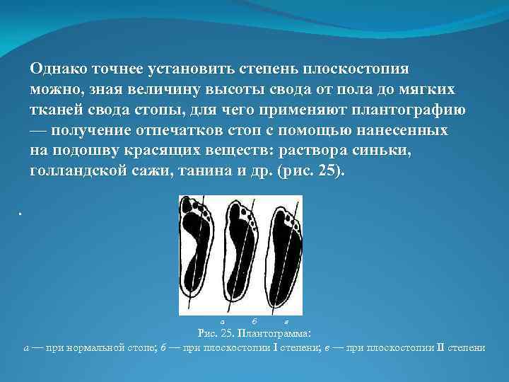 Однако точнее установить степень плоскостопия можно, зная величину высоты свода от пола до мягких