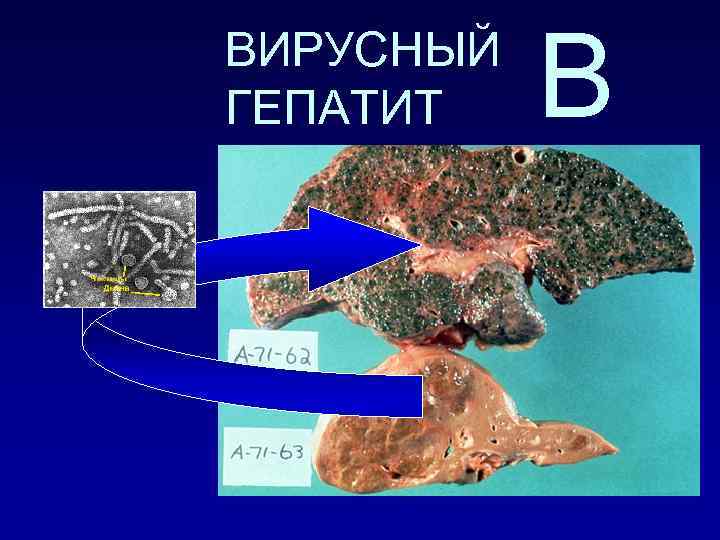 ВИРУСНЫЙ ГЕПАТИТ В 
