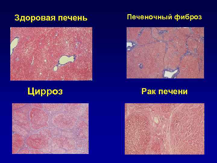 Здоровая печень Цирроз Печеночный фиброз Рак печени 
