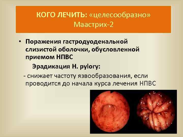 КОГО ЛЕЧИТЬ: «целесообразно» Маастрих-2 • Поражения гастродуоденальной слизистой оболочки, обусловленной приемом НПВС Эрадикация H.