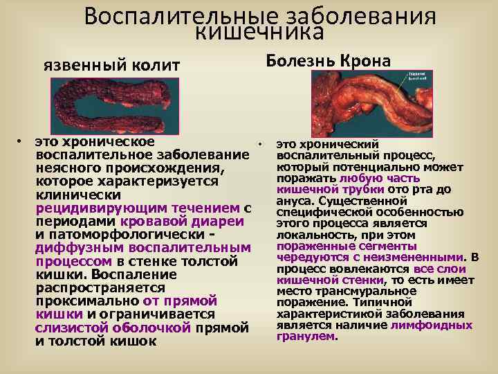 Воспалительные заболевания кишечника язвенный колит • это хроническое • воспалительное заболевание неясного происхождения, которое