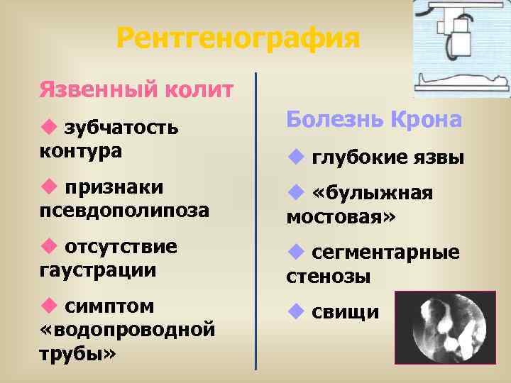 Рентгенография Язвенный колит u зубчатость контура Болезнь Крона u признаки псевдополипоза u «булыжная мостовая»