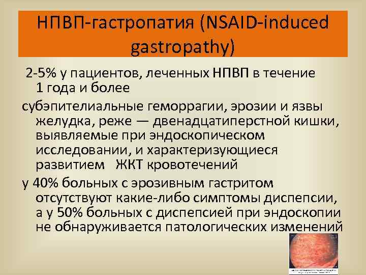 НПВП-гастропатия (NSAID-induced gastropathy) 2 -5% у пациентов, леченных НПВП в течение 1 года и