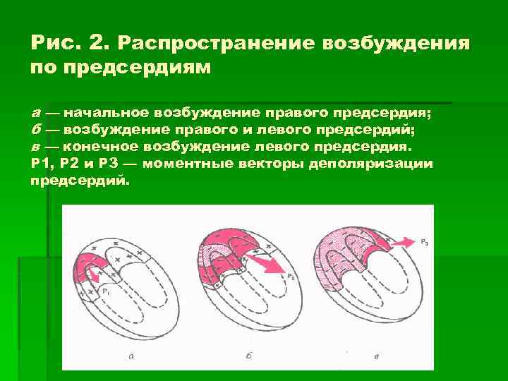 Рис. 2. Распространение возбуждения по предсердиям а — начальное возбуждение правого предсердия; б —