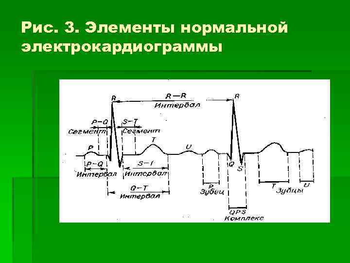 Рис. 3. Элементы нормальной электрокардиограммы 