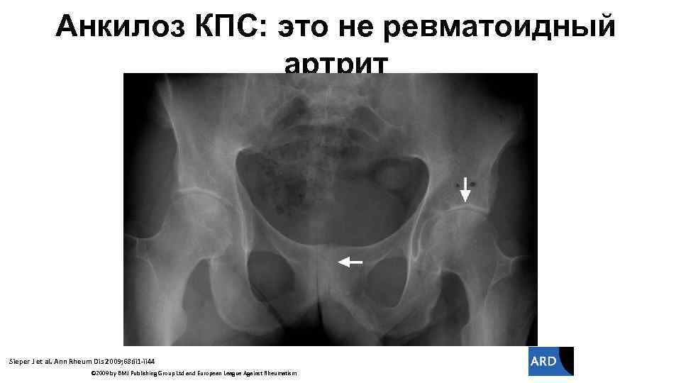 Анкилоз это. Крестцово-подвздошное сочленение. Блокада крестцово-подвздошного сочленения. Рентген крестцово-подвздошных сочленений. Кт крестцово-подвздошных сочленений.