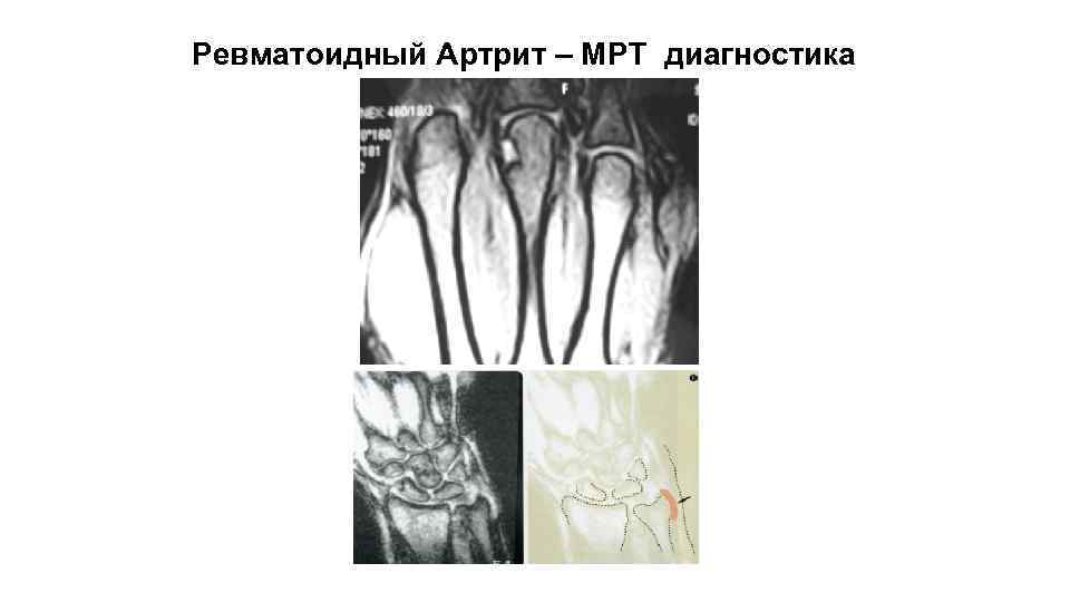 Ревматоидный Артрит – МРТ диагностика 