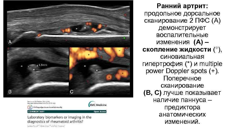 Ранний артрит: продольное дорсальное сканирование 2 ПФС (А) демонстрирует воспалительные изменения (A) – скопление