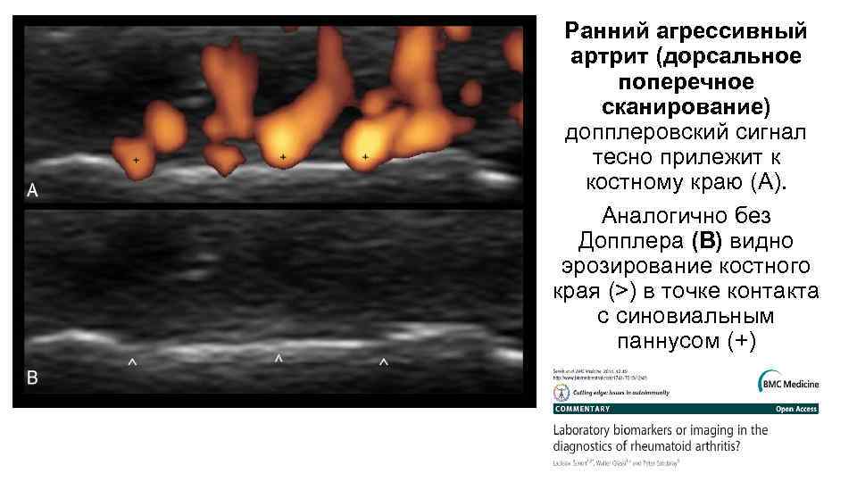 Ранний агрессивный артрит (дорсальное поперечное сканирование) допплеровский сигнал тесно прилежит к костному краю (A).