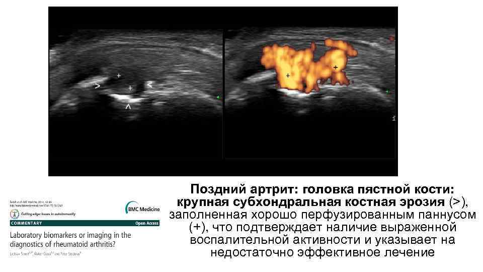 Поздний артрит: головка пястной кости: крупная субхондральная костная эрозия (>), заполненная хорошо перфузированным паннусом