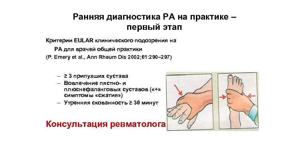 Ранняя диагностика РА на практике – первый этап Критерии EULAR клинического подозрения на РА