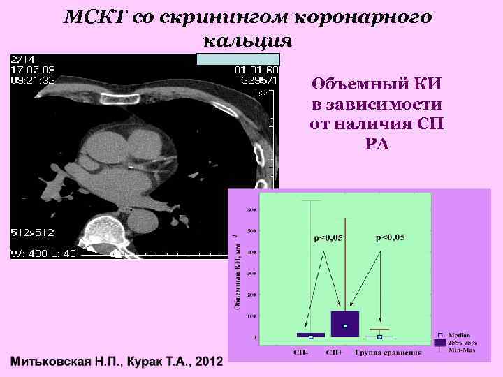 МСКТ со скринингом коронарного кальция Объемный КИ в зависимости от наличия СП РА 