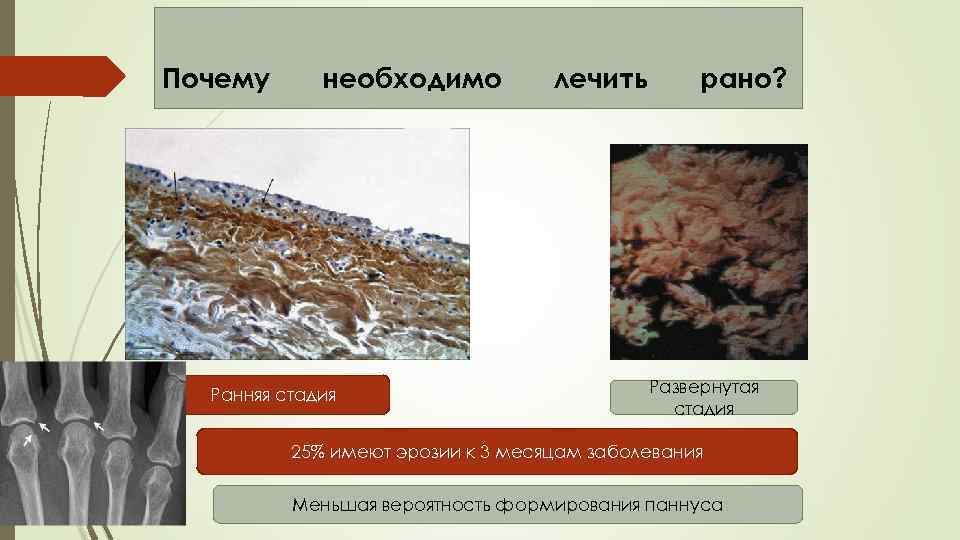 Почему необходимо Ранняя стадия лечить рано? Развернутая стадия 25% имеют эрозии к 3 месяцам