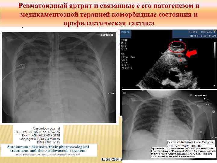 Ревматоидный артрит и связанные с его патогенезом и медикаментозной терапией коморбидные состояния и профилактическая