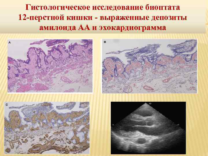 Гистологическое исследование биоптата 12 -перстной кишки - выраженные депозиты амилоида АА и эхокардиограмма 