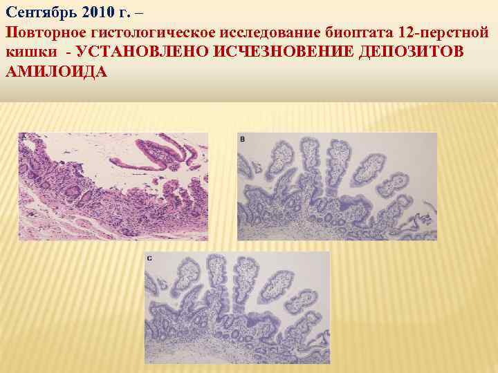 Сентябрь 2010 г. – Повторное гистологическое исследование биоптата 12 -перстной кишки - УСТАНОВЛЕНО ИСЧЕЗНОВЕНИЕ