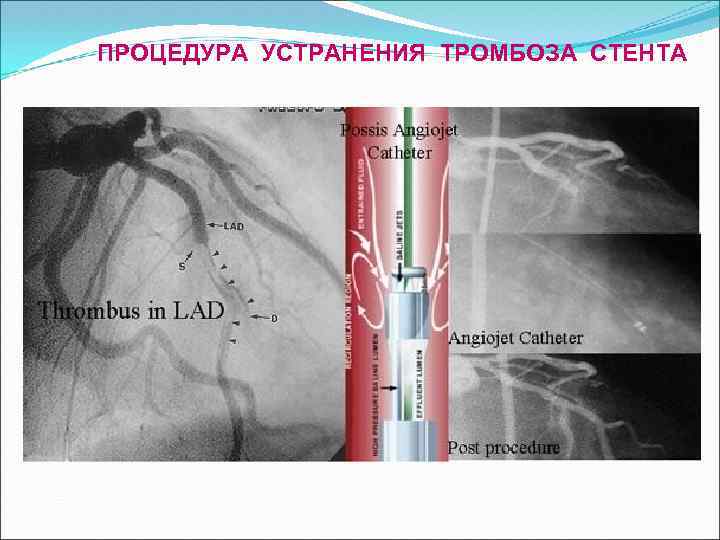 ПРОЦЕДУРА УСТРАНЕНИЯ ТРОМБОЗА СТЕНТА 