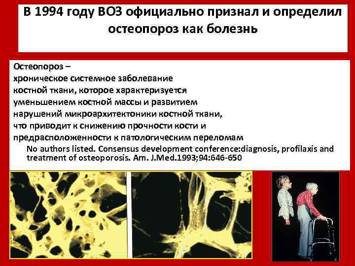 В 1994 году ВОЗ официально признал и определил остеопороз как болезнь Остеопороз – хроническое