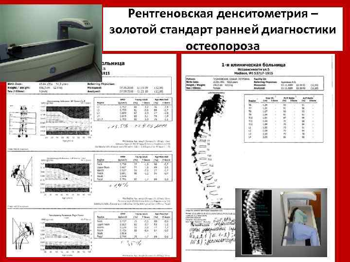 Рентгеновская денситометрия – золотой стандарт ранней диагностики остеопороза 