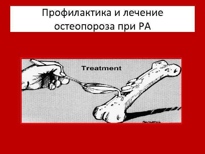 Профилактика и лечение остеопороза при РА 