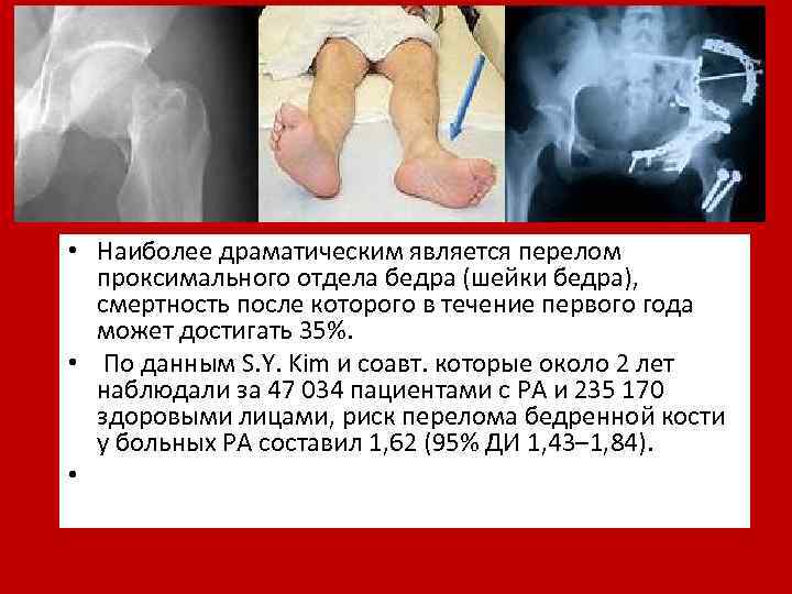  • Наиболее драматическим является перелом проксимального отдела бедра (шейки бедра), смертность после которого