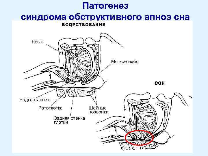 Патогенез синдрома обструктивного апноэ сна 