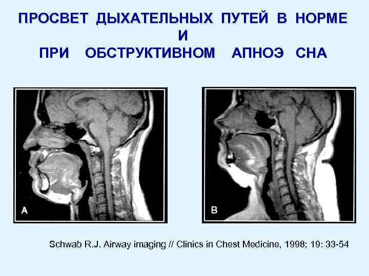 ПРОСВЕТ ДЫХАТЕЛЬНЫХ ПУТЕЙ В НОРМЕ И ПРИ ОБСТРУКТИВНОМ АПНОЭ СНА Schwab R. J. Airway