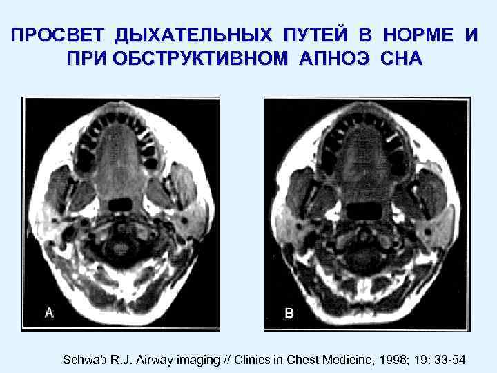 ПРОСВЕТ ДЫХАТЕЛЬНЫХ ПУТЕЙ В НОРМЕ И ПРИ ОБСТРУКТИВНОМ АПНОЭ СНА Schwab R. J. Airway