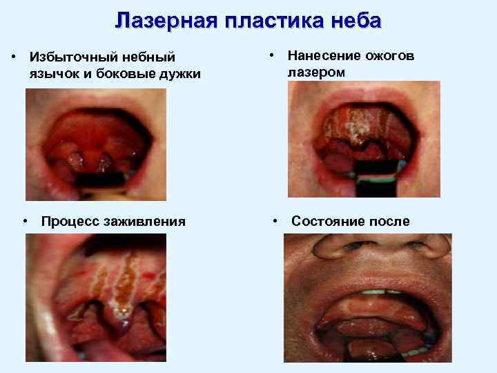 Лазерная пластика неба • Избыточный небный язычок и боковые дужки • Нанесение ожогов лазером