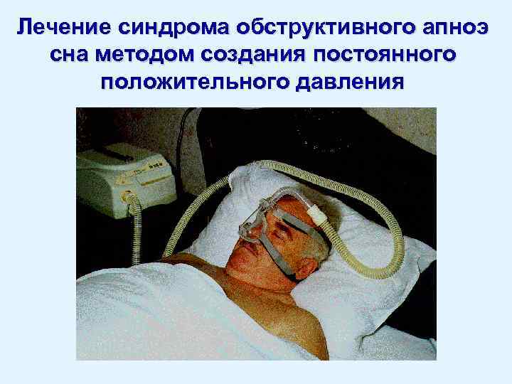 Лечение синдрома обструктивного апноэ сна методом создания постоянного положительного давления 