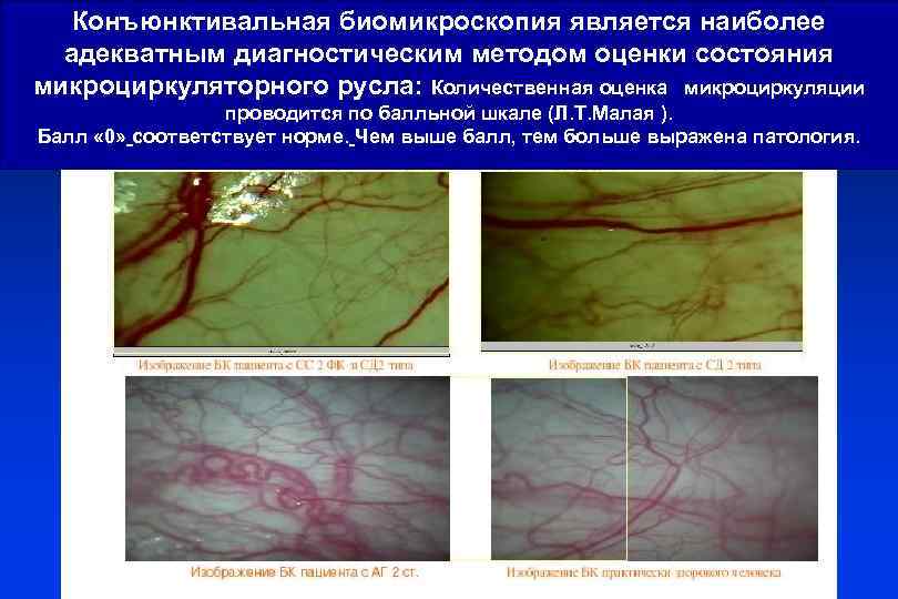 Конъюнктивальная биомикроскопия является наиболее адекватным диагностическим методом оценки состояния микроциркуляторного русла: Количественная оценка микроциркуляции
