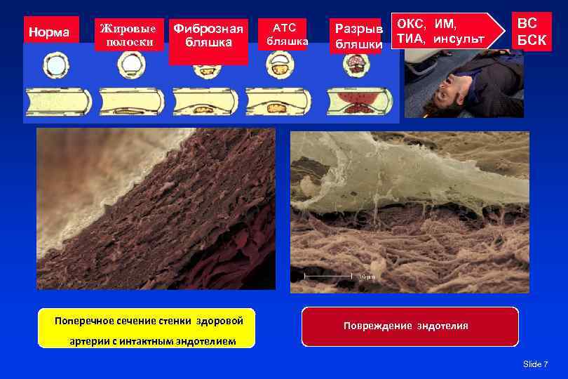 Норма Жировые полоски Фиброзная бляшка Поперечное сечение стенки здоровой АТС бляшка Разрыв бляшки ОКС,