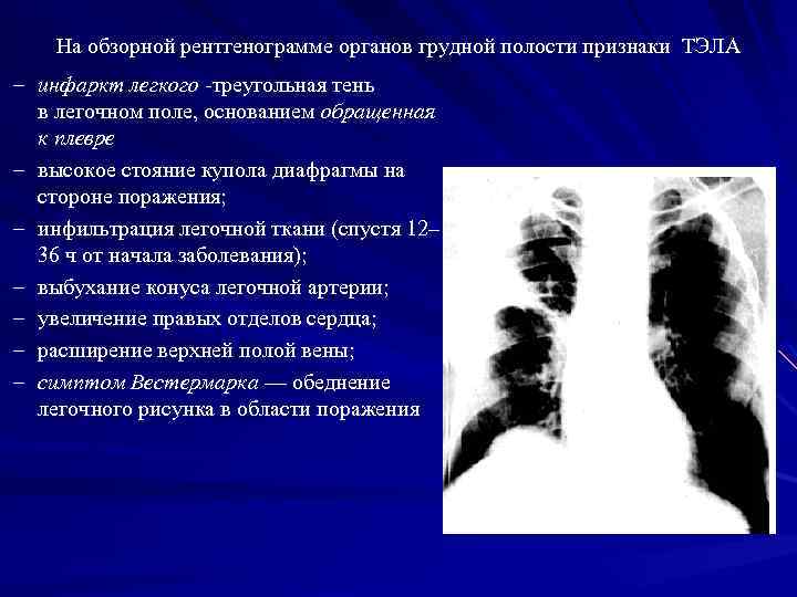 На обзорной рентгенограмме органов грудной полости признаки ТЭЛА – инфаркт легкого -треугольная тень в