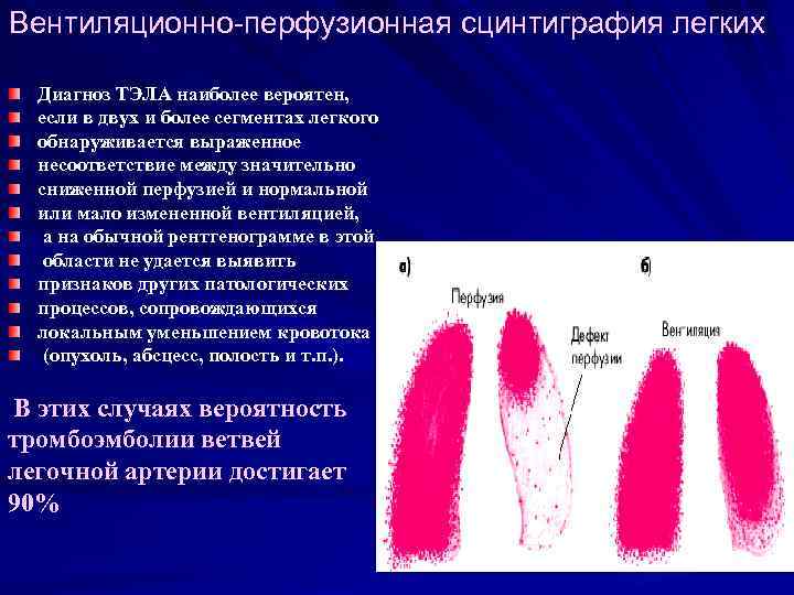 Вентиляционно-перфузионная сцинтиграфия легких Диагноз ТЭЛА наиболее вероятен, если в двух и более сегментах легкого