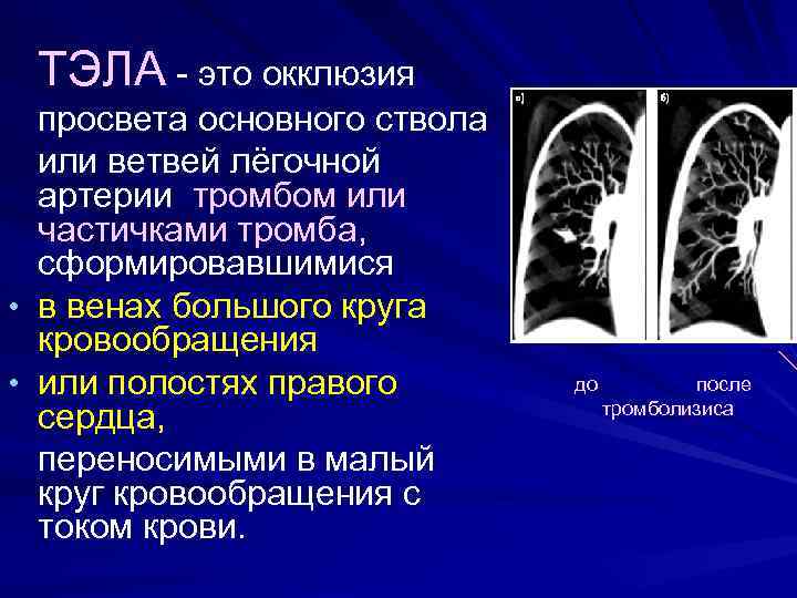  ТЭЛА - это окклюзия просвета основного ствола или ветвей лёгочной артерии тромбом или