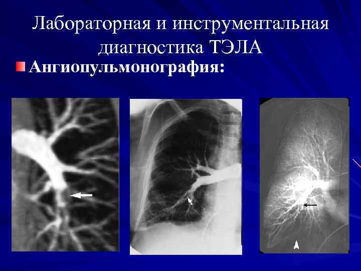 Лабораторная и инструментальная диагностика ТЭЛА Ангиопульмонография: 