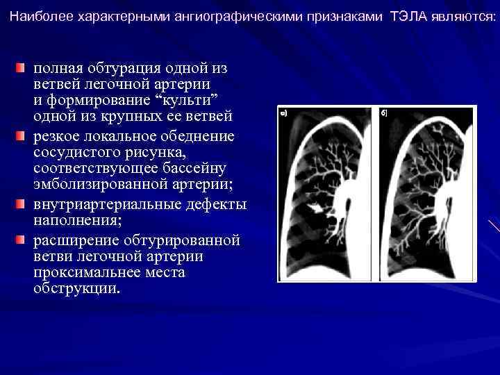 Наиболее характерными ангиографическими признаками ТЭЛА являются: полная обтурация одной из ветвей легочной артерии и