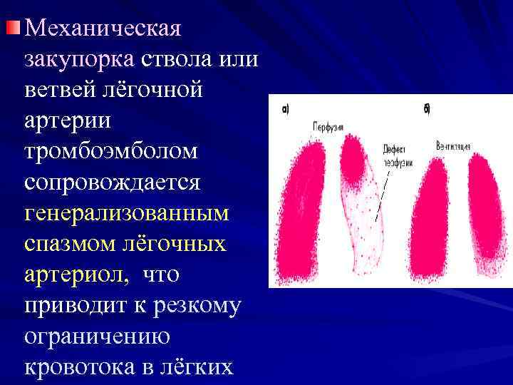 Механическая закупорка ствола или ветвей лёгочной артерии тромбоэмболом сопровождается генерализованным спазмом лёгочных артериол, что