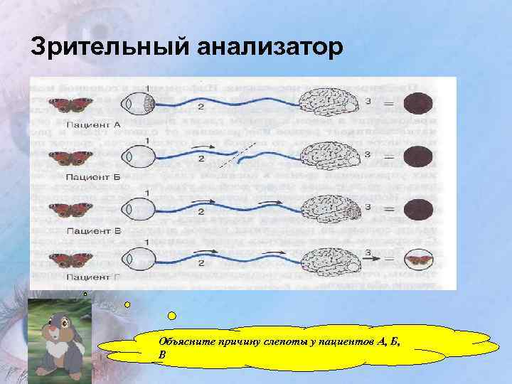 Зрительный анализатор Объясните причину слепоты у пациентов А, Б, В 