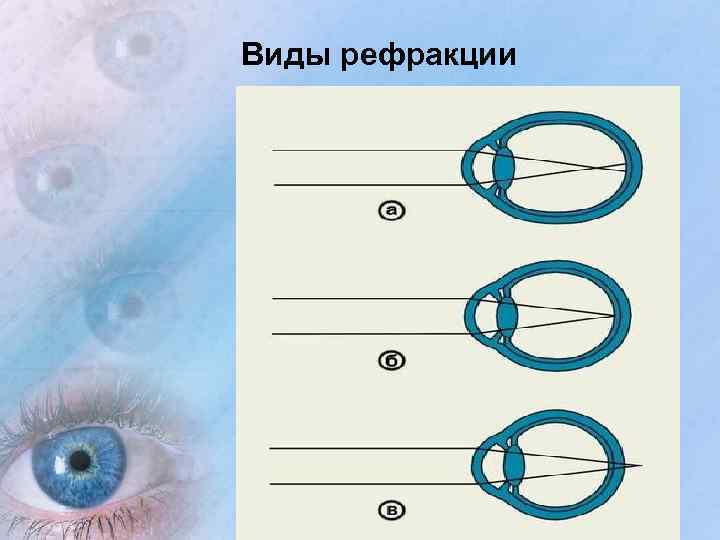 Виды рефракции 