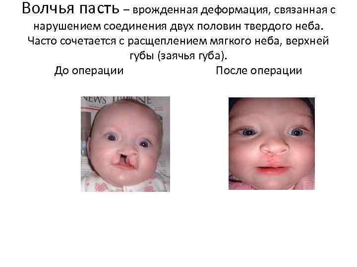 Волчья пасть – врожденная деформация, связанная с нарушением соединения двух половин твердого неба. Часто