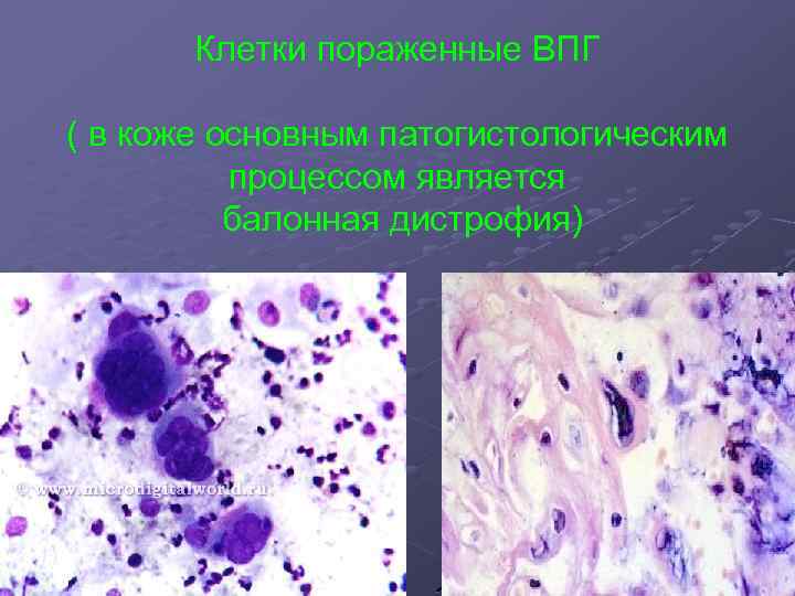 Клетки пораженные ВПГ ( в коже основным патогистологическим процессом является балонная дистрофия) 