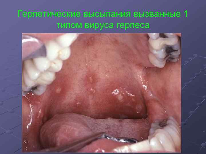 Герпетические высыпания вызванные 1 типом вируса герпеса 