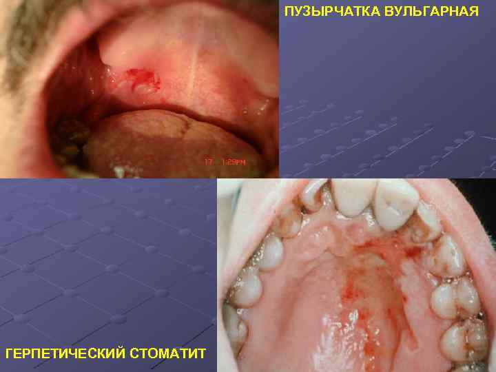 ПУЗЫРЧАТКА ВУЛЬГАРНАЯ ГЕРПЕТИЧЕСКИЙ СТОМАТИТ 