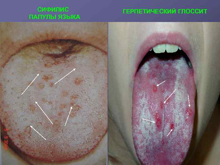СИФИЛИС ПАПУЛЫ ЯЗЫКА ГЕРПЕТИЧЕСКИЙ ГЛОССИТ 