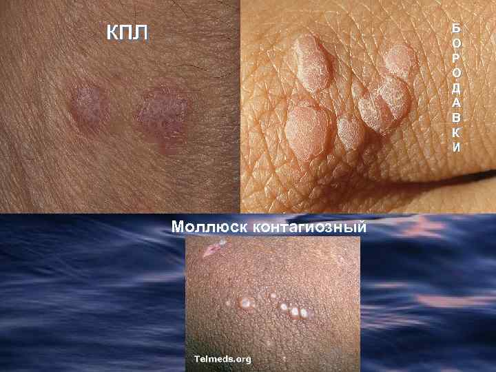 кпл Б О Р О Д А В К И Моллюск контагиозный 