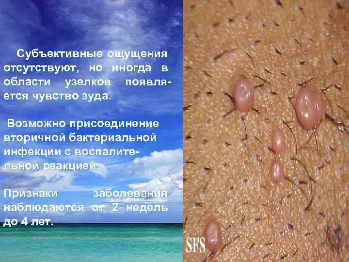 Субъективные ощущения отсутствуют, но иногда в области узелков появляется чувство зуда. Возможно присоединение вторичной