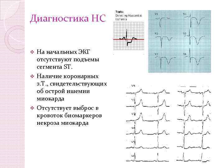 Диагностика НС На начальных ЭКГ отсутствуют подъемы сегмента ST. v Наличие коронарных з. Т.