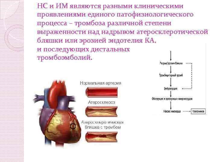 НС и ИМ являются разными клиническими проявлениями единого патофизиологического процесса – тромбоза различной степени